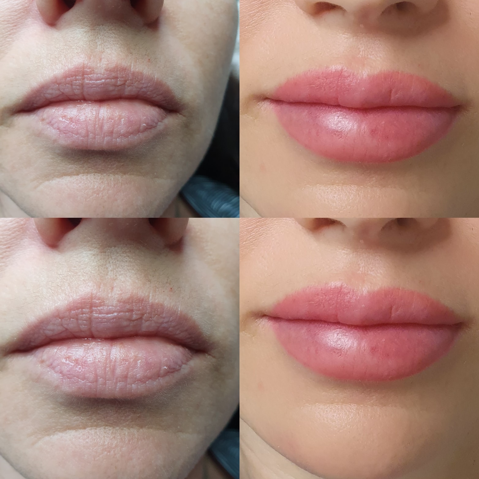 Kosmetisk läpptatuering- Lip blush (2 av 6)