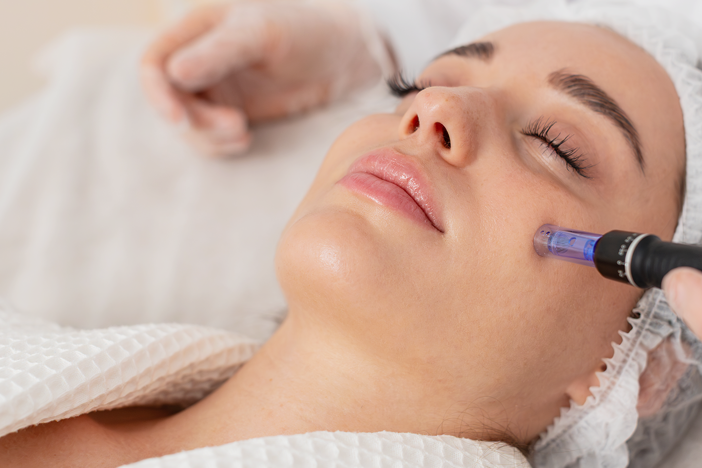 Microneedling med lax-DNA serum och rödljusterapi i Trelleborg