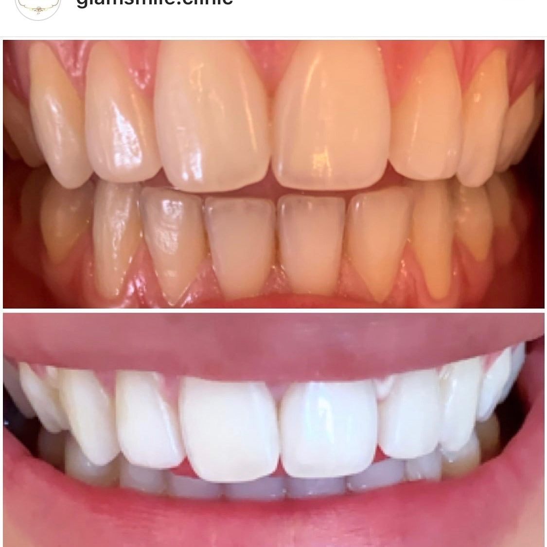 Glam Smiles tandblekning för hemmabruk (3 av 4)