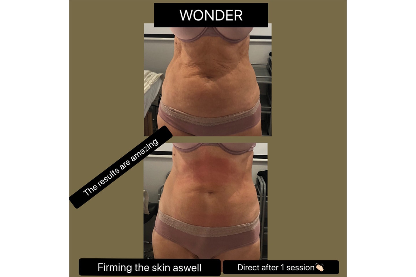 Bygg muskler och bränn fett med Wonder Axon Hos Tumba LipoKliniken (6 av 11)