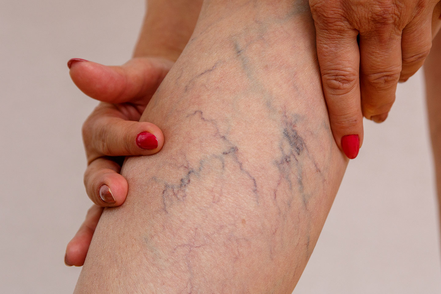 Ta bort ytliga blodkärl med laser hos Lemoge Clinic i Södra Uppsala