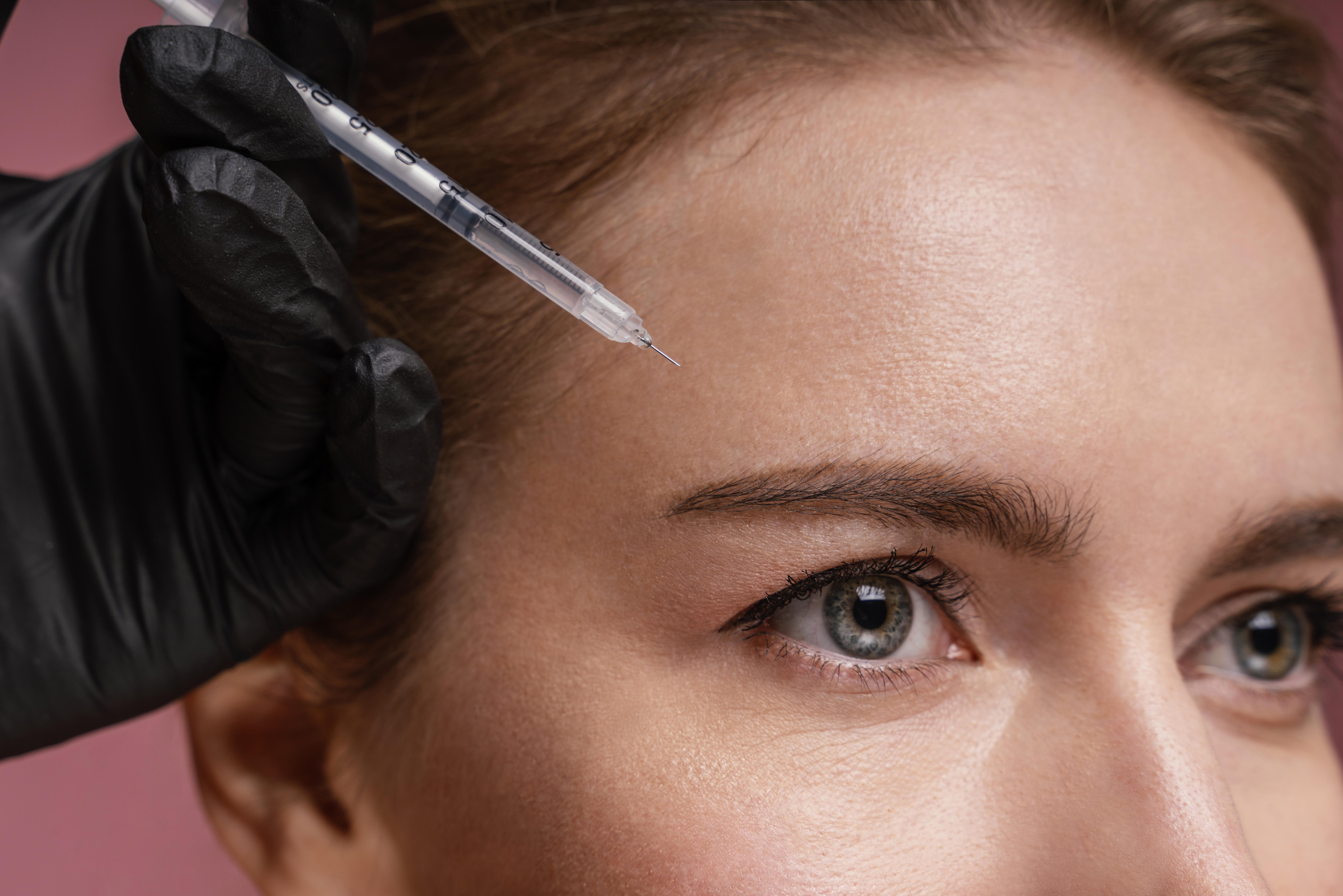 Full Face Lift med 5 ml filler hos NurseLab i Majorna
