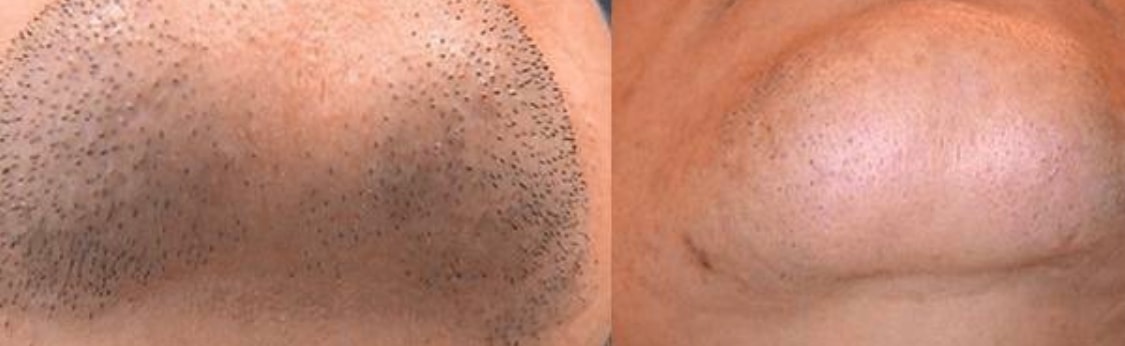 Permanent hårborttagning med laser hos Alfa Skönhetsklinik (4 av 6)