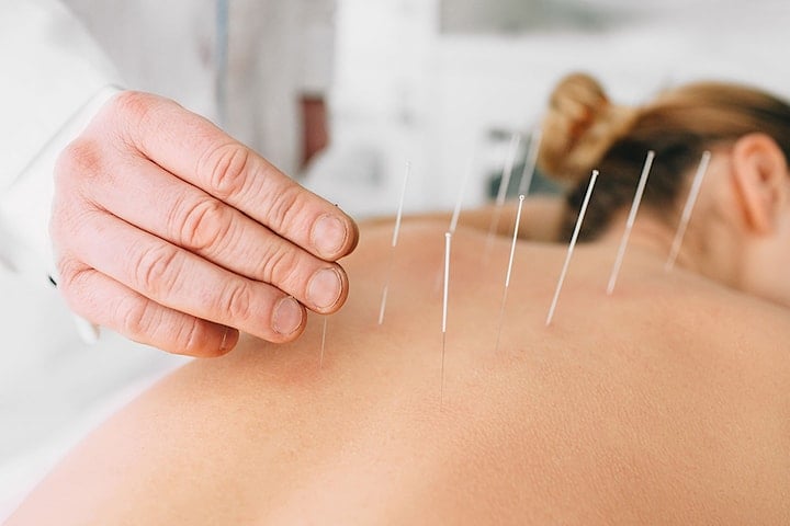Taoistisk akupunktur för nacke, rygg eller axlar hos Unikvård