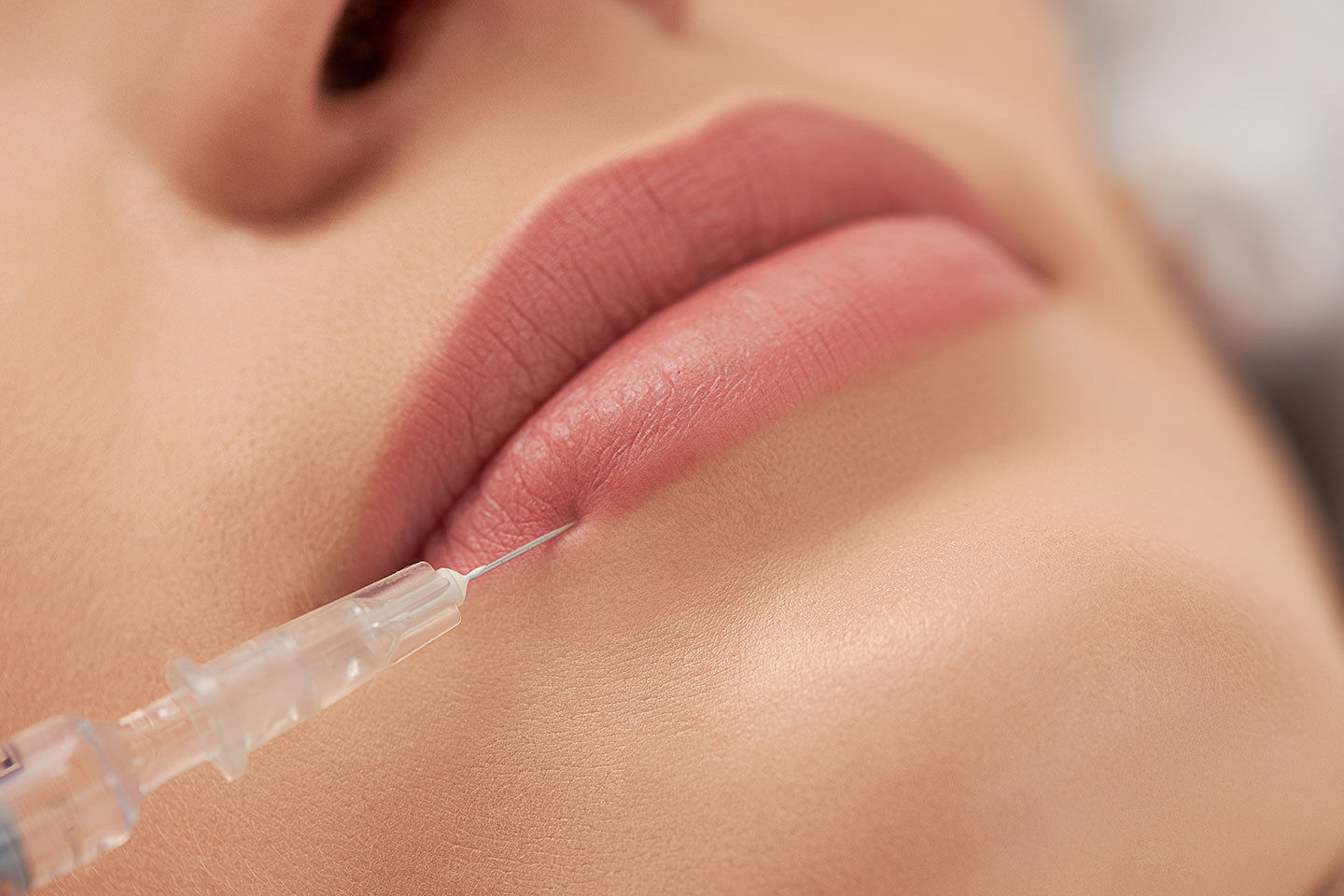 Fillers 0,5-1 ml på valfritt område hos Atlantic Clinic i Lorensberg