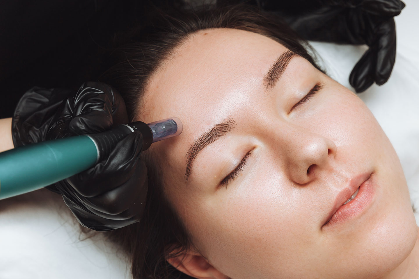 Microneedling med tillväxtfaktorer för hudföryngring på Backaplan
