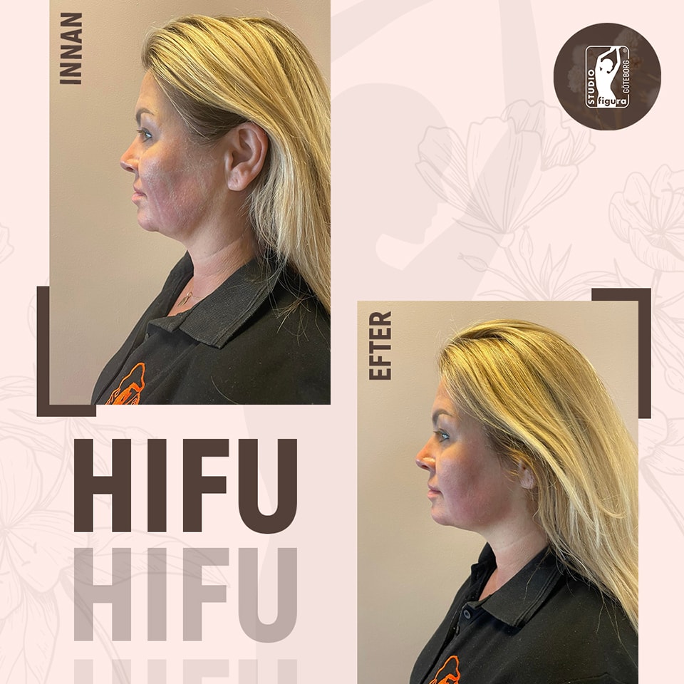 HIFU behandling hos Studio Figura (5 av 6) (6 av 6)