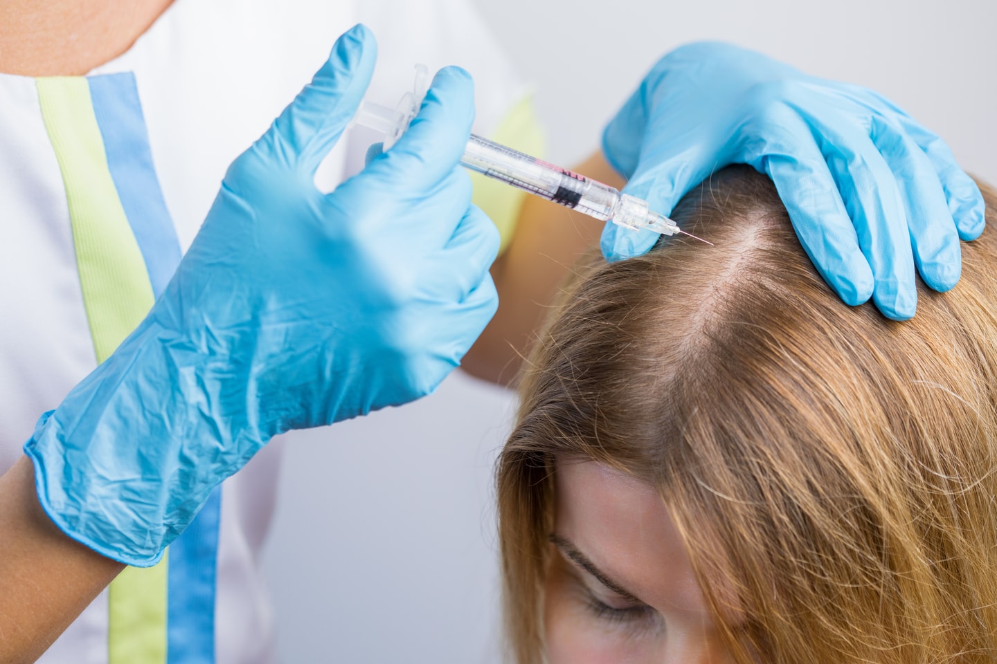 Mesoterapi mot håravfall för män och kvinnor (1 av 3)