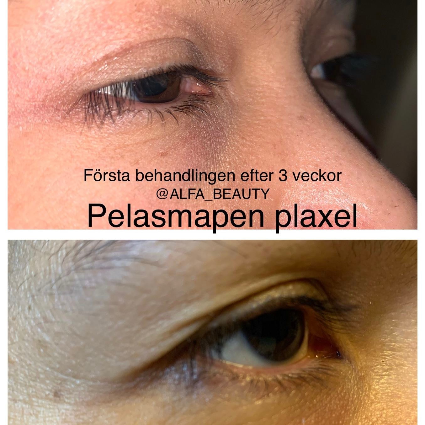 Plasmapen Plaxel plus hos Alfa Skönhetsklinik (2 av 8) (3 av 8)