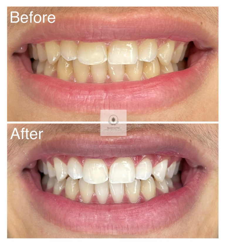 Klinisk tandblekning utförd av tandläkare (2 av 3)