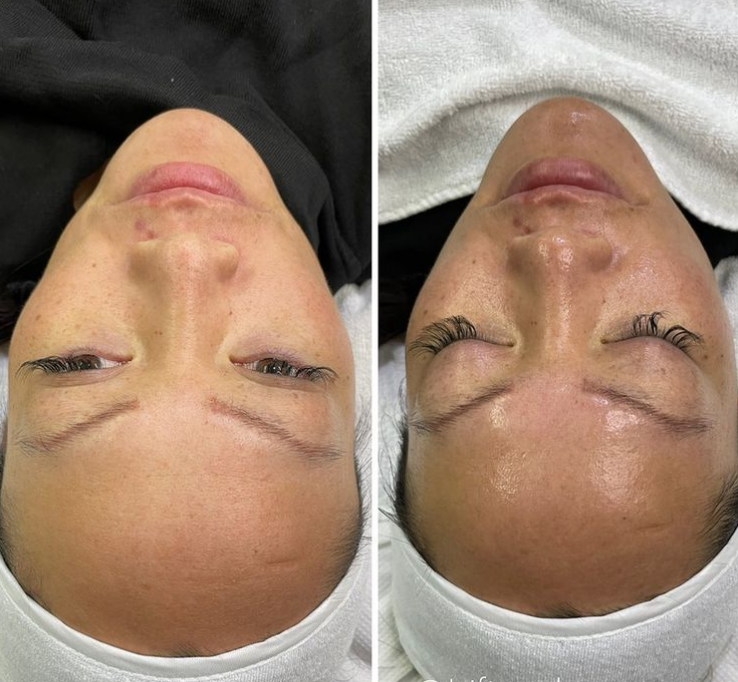 Hydra facial ansiktsbehandling hos Zeylakliniken (2 av 8)