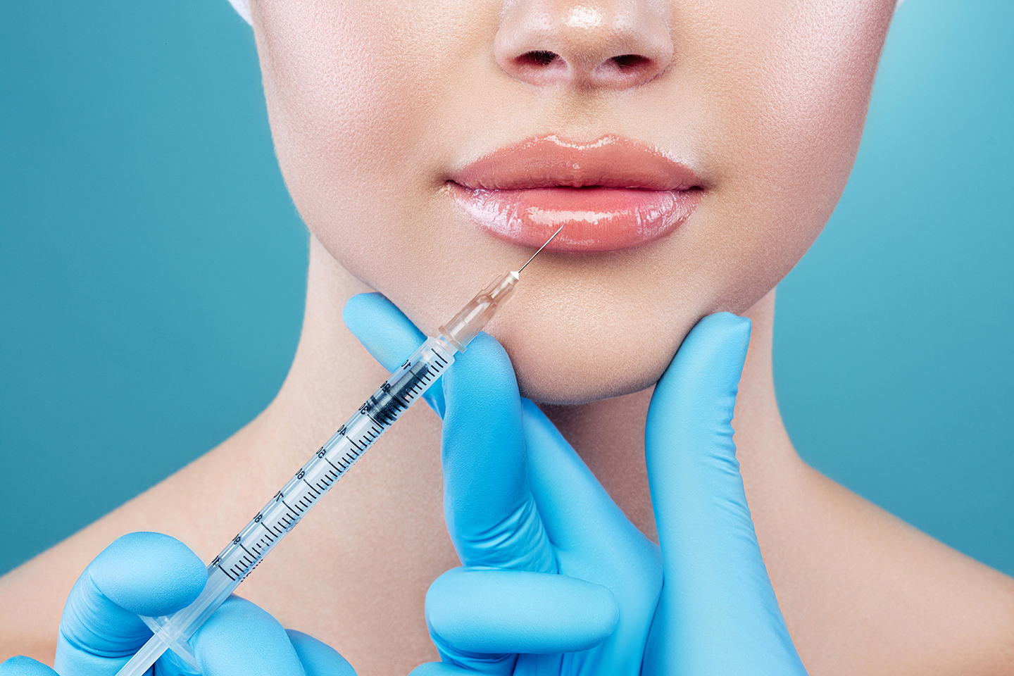 Injektionsbehandling med fillers 1-2 ml för valfritt område