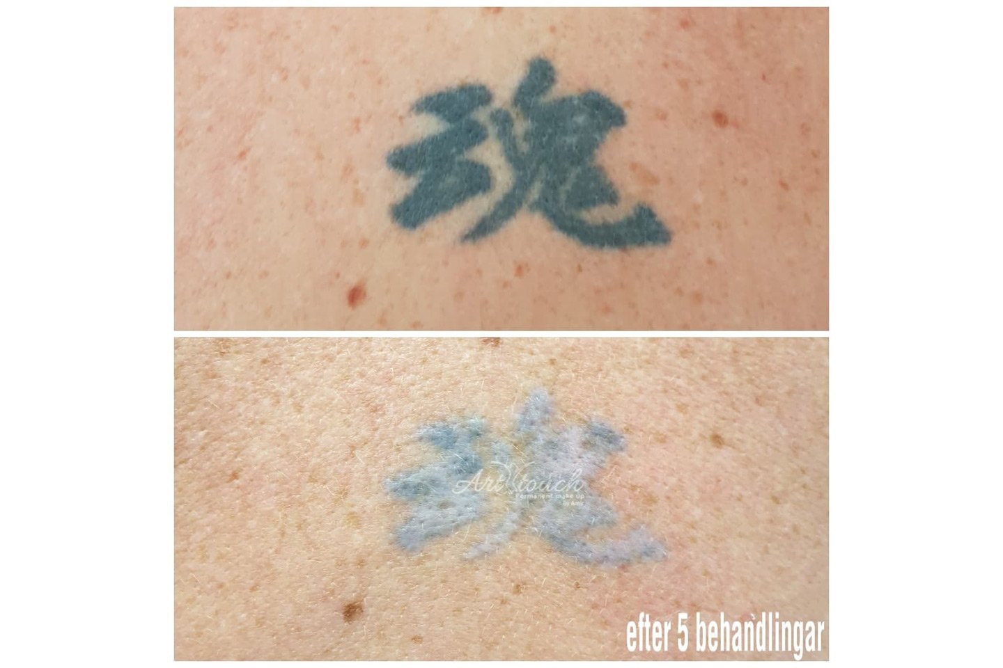Tatueringsborttagning med laser (2 av 5)