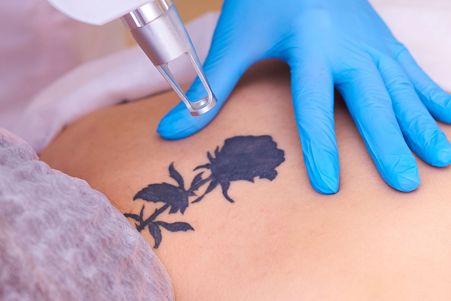 Tatueringsborttagning med Pico Laser i Örgryte